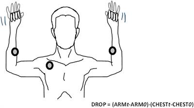 Microvascular Response to the Roos Test Has Excellent Feasibility and Good Reliability in Patients With Suspected Thoracic Outlet Syndrome